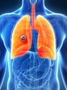 Male lung - cancer Royalty Free Stock Photo
