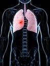 Male lung - cancer Royalty Free Stock Photo