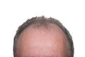 Male Pattern Baldness Royalty Free Stock Photo