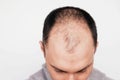 Male pattern hair loss problem, close up Royalty Free Stock Photo