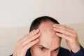 Male pattern hair loss problem concept. Baldness, alopecia in males Royalty Free Stock Photo