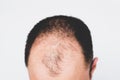 Male pattern hair loss problem concept. Baldness, alopecia in males