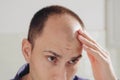 Male pattern hair loss problem concept. Baldness, alopecia in males