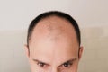 Male pattern hair loss problem concept. Baldness, alopecia in males Royalty Free Stock Photo