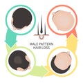 Male pattern baldness four steps infographics template