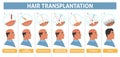 Male person hair transplantation step info poster Royalty Free Stock Photo