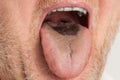 Black hairy tongue closeup