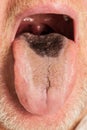 Black hairy tongue closeup