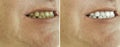 Male teeth before and after bleaching, treatment Royalty Free Stock Photo