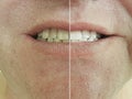 Male close-up teeth before and after bleaching,  treatment Royalty Free Stock Photo