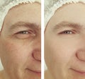 Male wrinkles before   after aging  treatments Royalty Free Stock Photo