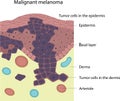 Malignant melanoma. Skin disease. Skin cancer