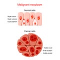 Malignant neoplasm. Cancer and Normal cells Royalty Free Stock Photo