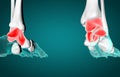3D illustration of malleolus or talus foot bone