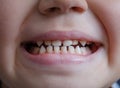 Malocclusion of the boy. open mouth Royalty Free Stock Photo
