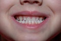 Malocclusion of a child, close-up on the front teeth of a child