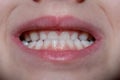 Malocclusion of a child, close-up on the front teeth of a child