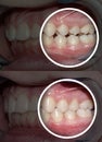 Malocclusion after and before orthodontic treatment