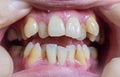 Malocclusion, Overcrowding of both upper and lower teeth Royalty Free Stock Photo