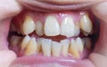 Malocclusion, Overcrowding of both upper and lower teeth Royalty Free Stock Photo