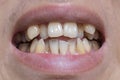 Malocclusion, Overcrowding of both upper and lower teeth Royalty Free Stock Photo