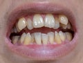 Malocclusion, Overcrowding of both upper and lower teeth Royalty Free Stock Photo