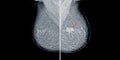 Mammogram radio imaging for breast cancer diagnosis