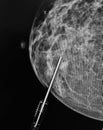 Mammography biopsy needle pathological zone Royalty Free Stock Photo