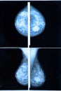 Mammography