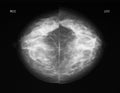 Mammography in CC projection Royalty Free Stock Photo