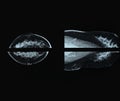 Mammography x-ray film image for breast cancer