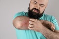 Man with allergy symptoms scratching forearm, closeup Royalty Free Stock Photo