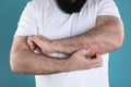 Man with allergy symptoms scratching forearm on color background Royalty Free Stock Photo