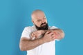 Man with allergy symptoms scratching forearm Royalty Free Stock Photo