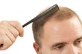 Man alopecia baldness hair loss isolated Royalty Free Stock Photo