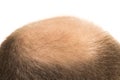 Man alopecia baldness hair loss isolated Royalty Free Stock Photo