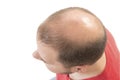 Man alopecia baldness hair loss isolated Royalty Free Stock Photo