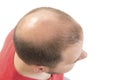 Man alopecia baldness hair loss isolated Royalty Free Stock Photo