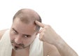 Man alopecia baldness hair loss isolated Royalty Free Stock Photo