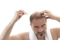 Man alopecia baldness hair loss isolated Royalty Free Stock Photo