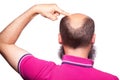 Man alopecia baldness hair loss isolated. Royalty Free Stock Photo