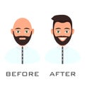 Man with alopecia problem before and after hair treatment and transplantation. Male baldness set in cartoon style