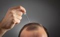 Man applying dropper vitamin on head. Baldness treatment concept