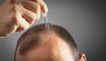 Man applying dropper vitamin on head. Baldness treatment concept