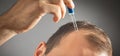 Man applying dropper vitamin on head. Baldness treatment concept