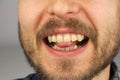 Man with a beard bites the tip of the tongue with his teeth