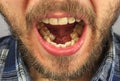 Man with a beard opened his mouth for dental examination of lowe