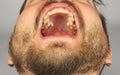 man with a beard opened his mouth for dental examination of uppe