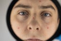 Acne and black dots close-up. A man is being examined by a doctor. Dermatologist examines the skin through a magnifier, a magnifyi