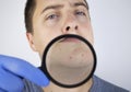 Acne close-up. A man is being examined by a doctor. Dermatologist examines the skin through a magnifier, a magnifying glass